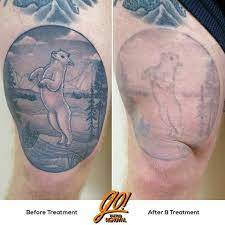 According to the american society for aesthetic plastic surgery, the number of people undergoing laser tattoo removal went up by 43 percent from 2011 to 2012. Go Tattoo Removal Twitterissa 24 Months From Start Until 8 Treatments Tattoo Removal Does Not Happen Over Night And Usually Requires 10 12 Treatments Every Tattoo Will Have Different Results We