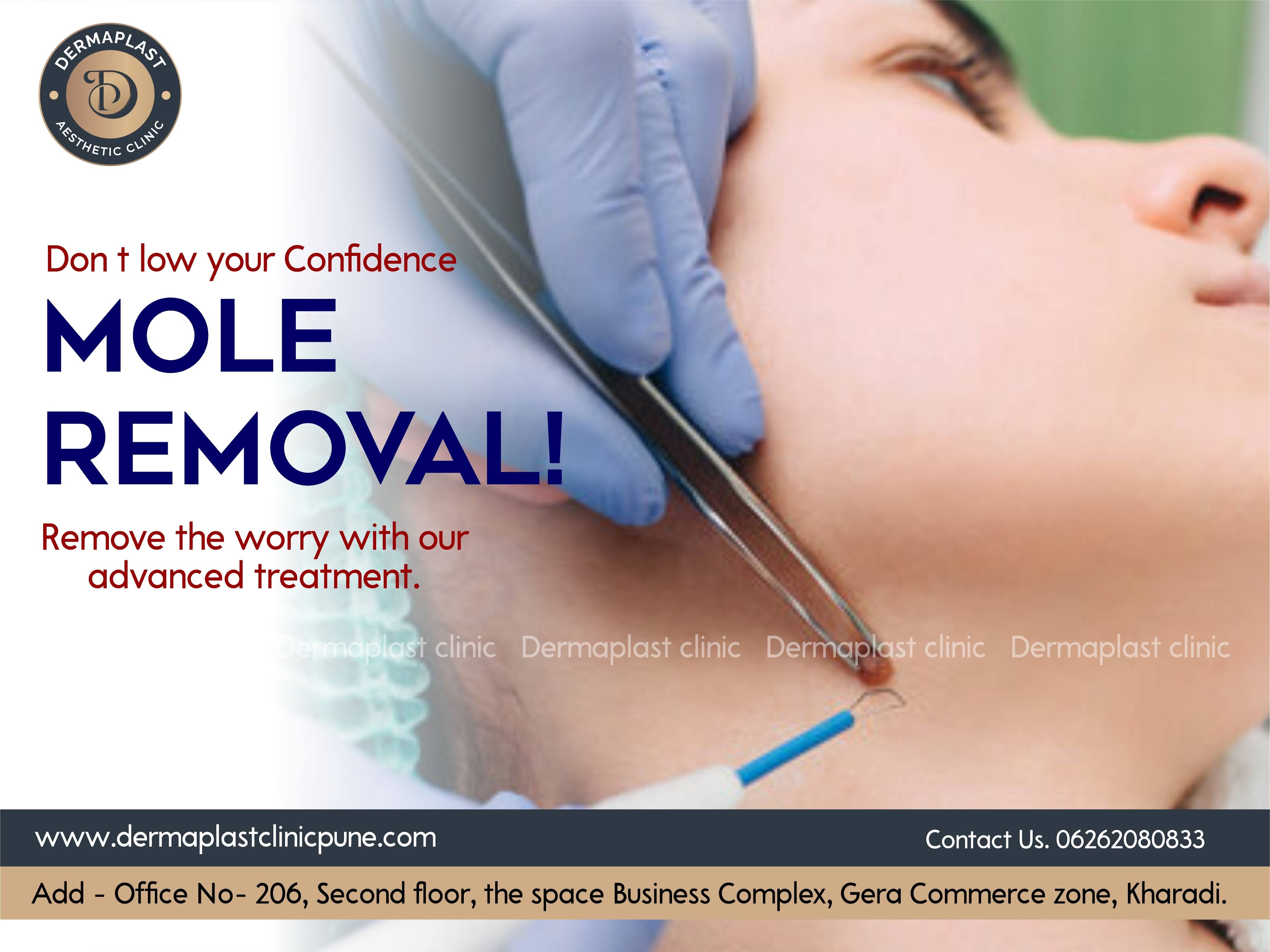 Mole Removal Treatment product image