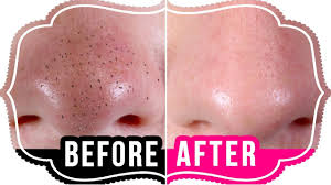 Image result for blackheads before and after