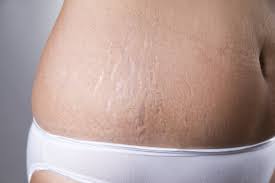 These two ladies are gorgeous. Stretch Mark Removal Surgery What New Moms Need To Know Parents
