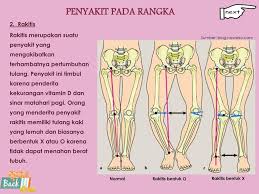 Hay dokter saya mau bertanya bagaimana cara mencegah terjadinya kelainan kaki berbentuk x dan o. Memelihara Kesehatan Rangka Tubuh Kelainan Dan Penyakit Pada Rangka Ppt Download