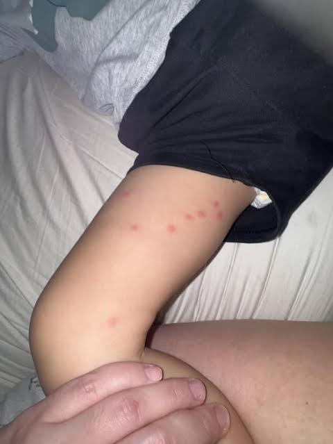My toddler woke up with these tiny red bumps clustered all around his  ankles The nurse line is completely busy and he keeps scratching them What  is this