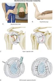 Image result for Shoulder Instability Exam