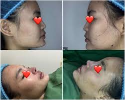 SILICON IMPLANT RHINOPLASTY ❤️ Before and After Doctor: Dr. Erin Tan👨‍⚕️  Facebook Page: Doc Erin Babies ❤️ @ Prime Aesthetics And Varicose Vein  Treatment Center LOCATION: 📍 76 timog ave Quezon City