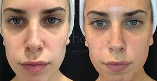 Reduced visibility of fine lines and wrinkles. Aquagold Fine Touch Nicholsmd Of Greenwich