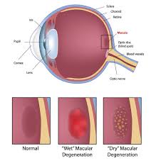 Cataract Surgery Chandler Az Lasik Mesa Swagel Wootton
