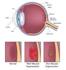 cataract surgery chandler az lasik mesa swagel wootton