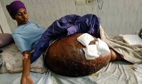 Can i tap fuel from that factory pls. Doctors Remove Giant 55kg Tumour World S Largest That Weighed More Than The Patient World News Express Co Uk