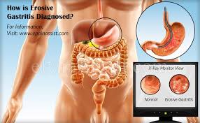 Erosive Gastritis Causes Symptoms Treatment Home Remedies Diet