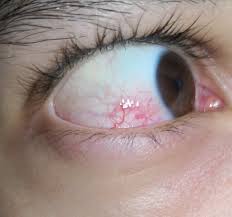 Findet Ihr Meine Augen Gelb Gesundheit Rote Augen Gelbe Augen