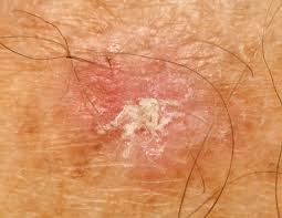Squamous cell carcinoma of the skin is a common form of skin cancer that develops in the squamous cells that make up the middle and outer layers of the skin. Can Skin Cancer Come And Go Scary Symptoms