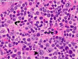 Angioimmunoblastic t cell lymphoma (aitl) is a rare but distinct type of t cell lymphoma with an aggressive course and high mortality. Histopathology Images Of Angioimmunoblastic T Cell Lymphoma Aitl By Pathpedia Com Pathology E Atlas