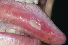 Image result for mouth ulcer on tongue)