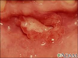 Image result for Canker sores symptoms roof of the mouth