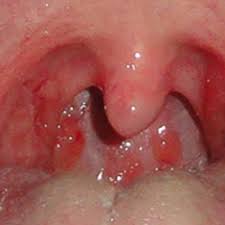 What does throat cancer look. Throat Cancer Stage 3 Dr Joel Wallach By The Wallach Log
