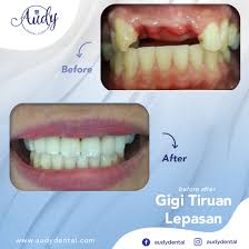 Check spelling or type a new query. Gigi Tiruan Lepasan Audy Dental