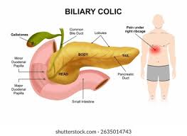Image result for Biliary Colic