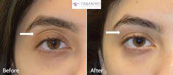 You get a great deal of choices there while you are also assisted by beauty experts. Eyelid Filler Injection Dark Circles Sunken Eyes Photos Mehryar Ray Taban Md