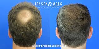 Hair transplant surgery has been heralded by some as the holy grail cure of hair loss. Hair Transplant Crown Area A Complete Guide To Crown Hair Transplants