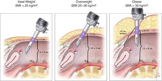 When umbilical entry is contraindicated we use the left upper quadrant or palmer's point. Basic Principles And Anatomy For The Laparoscopic Surgeon Springerlink