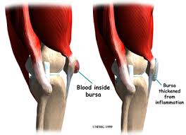 Image result for Prepatellar Bursitis