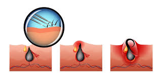 Exfoliating removes the dead skin cells that could potentially clog pores and helps lift the hairs away from the skin, allowing the razor to cut closer to the skin. How To Get Rid Of Ingrown Hair