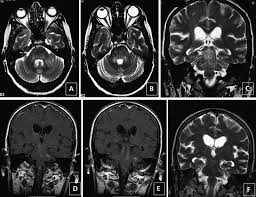 Unexpected diagnosis of spinal leptomeningeal metastatic disease on mri myelography. Https Academic Oup Com Jnen Article Pdf 74 2 186 17420081 74 2 186 Pdf