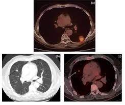 There is no sign that the cancer has spread outside of the colon or rectum. Management Of Non Hepatic Metastatic Disease In Colorectal Cancer Intechopen