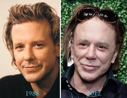 Mickey Rourke Plastic Surgery Before And After Mickey Rourke Plastic Surgery Plastic Surgery Gone Wrong Celebrity Plastic Surgery