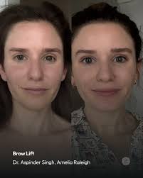 Just two weeks post-op from her awake brow lift with @dr.singh.amelia ✨The  change is subtle, but at just 34 she feels years younger and even has fewer  tension headaches now that she's