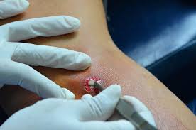 Abscess drainage