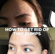 Tiny little bumps on the forehead. Overview Of A Bumpy Forehead Liz Claire