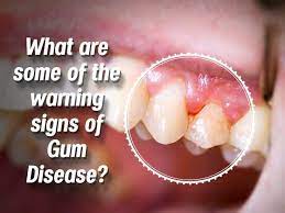 Taking Care Of Swollen Bleeding Gums Gum Disease Affordable Dentist Dental Clinic