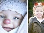 'I was terrified she'd be asked to play Rudolph in the school play':  Mother's relief after surgery to remove her daughter's birthmark is  successful