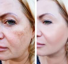 Detox tidak sebabkan oleh produk dari b erl cosmetic, karena memang bukan produk detox. Kenali Fakta Pigmentasi Pada Kulit Pure Laser Clinic Indonesia