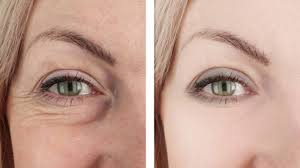 Six Tricks To Minimize Fine Lines And Crow S Feet Crows Feet Under Eye Wrinkles Wrinkle Remover