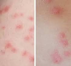 Image result for bedbugs bites