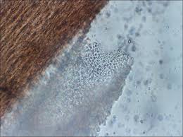 White piedra (wp) is a rare superficial mycosis that has been poorly described in the literature. Indian Journal Of Dermatology Venereology And Leprology Trichosporon Inkin And Trichosporon Mucoides As Unusual Causes Of White Piedra Of Scalp Hair