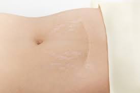 Streifen Am Bauch Ursachen Behandlung Hilfe Medlexi De