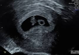 Zu diesem zeitpunkt kann manchmal ein fetaler. 8 Woche Baby Lt Fa Zu Klein Schwanger Wer Noch