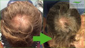 Hair loss affects tens of millions of americans — both men and women — for a number of reasons. Stem Cell For Hair Loss Dr Ben Behnam Md Faad Best Dermatologist Los Angeles