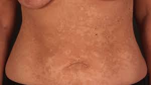 Pityriasis rosea, a rash that usually appears on the torso, upper arms, thighs or neck, may sound worse than it really is. Pityriasis Versicolor Overview Altmeyers Encyclopedia Department Dermatology