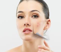 Baking soda ini menyerap masuk ke dalam pora kulit dan membersihkannya dan juga mengelakkan jerawat caranya: Petua Menjadi Untuk Hilangkan Parut Wajah Dah Cuba Baru Happy Keluarga