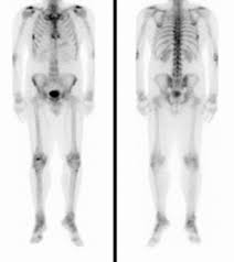 Although it is the most commonly diagnosed cancer in american women, breast cancer can impact people of all genders. Inconclusive Bone Scan In Men With Intermediate And High Risk Prostate Cancer What Next Sciencedirect