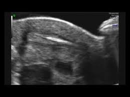 Just like a routine pelvic exam, a woman lies on an exam table. Embryo Transfer Procedure For In Vitro Fertilization Ivf