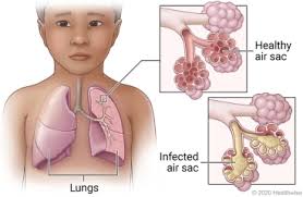 In most of the cases of pneumonia, the starting point of the disease is an infection in the upper portion of the if you find your baby showing the following symptoms then you should never hesitate but take. Pneumonia In Children Care Instructions