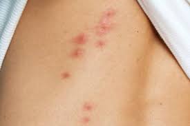 Maybe you would like to learn more about one of these? Como Quitar Las Cicatrices De Picaduras De Chinches Como Quitar Cicatrices Picadura De Chinche Como Quitar