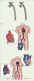 Skrg platform uang saku dh smkin kuat , brdasarkan info dari pelayanan platform , skrg banyak platform kecil yg tiru metode operasi uang saku , pinjam popularitas uang saku untk pura² jdi uang saku. Temporary Circulatory Support For Cardiogenic Shock The Lancet