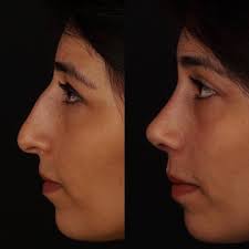 700 Mentions J Aime 11 Commentaires Prof Dr Fahrettin Yilmaz Fahrettin Yilmaz Sur Instagram Deg Nose Job Rhinoplasty Nose Jobs Nose Plastic Surgery
