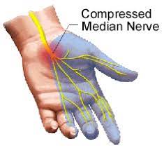 Carpal Tunnel Skiatook Chiropractic Clinic